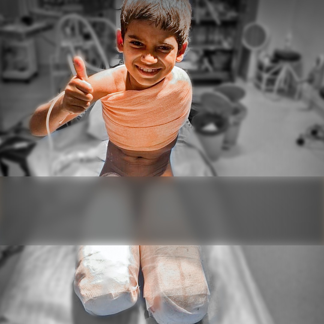 Little Nitish survives multiple amputations with donor support